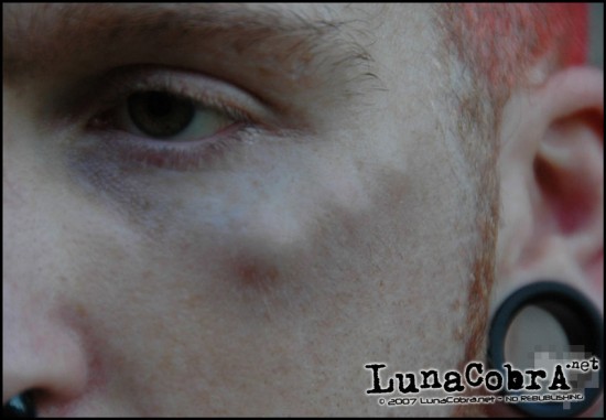 Anti-Eyebrow Implants (Healed) Anti-Eyebrow Implants (Healed)