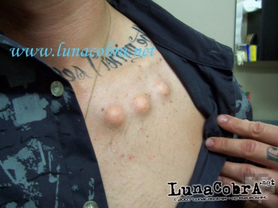 Chest dome implants Chest dome implants