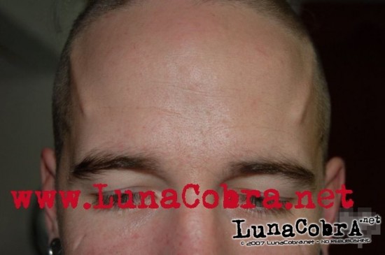 Forehead Ridges Forehead Ridges