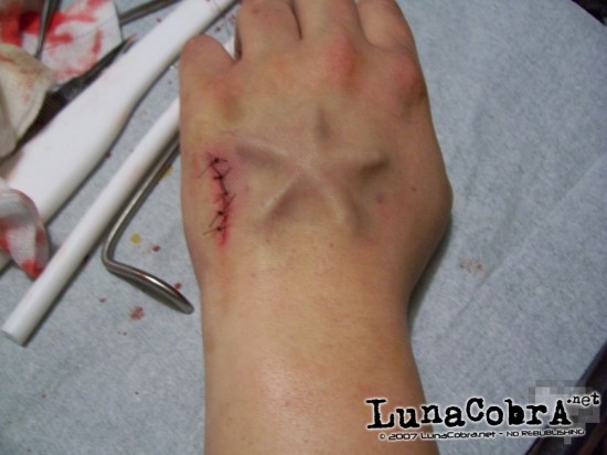 Implants Stary Implants Stary