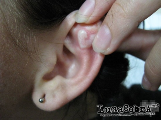 Implants Implants