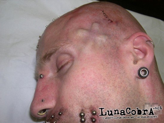 Implants Implants