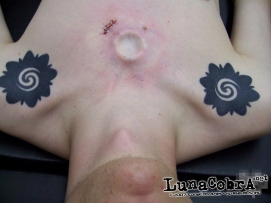 Implants Implants