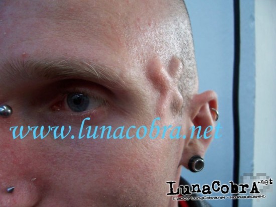 Implants Implants