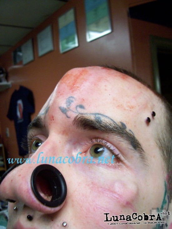 Paulys Forehead Implant Paulys Forehead Implant