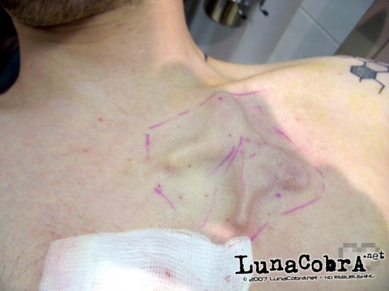 Silicone Implant Silicone Implant